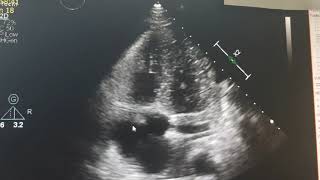 Infectious endocarditis Echocardiography [upl. by Htebi]