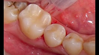 Kompozit dolgular Composite fillings [upl. by Mack]