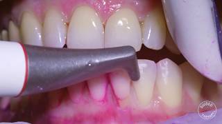 How teeth should be cleaned at the Dentist  Hygienist [upl. by Lehcim]