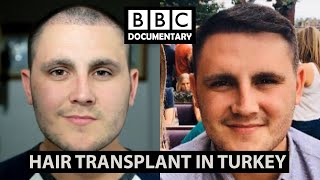 Hair Transplant Turkey  BBC Documentary  Paul Before amp After [upl. by Saduj525]