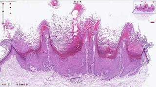 Verruca Vulgaris  Histopathology [upl. by Ruddy]