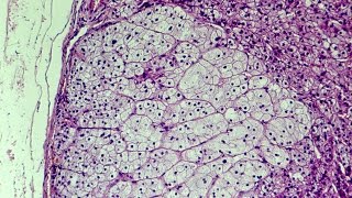 What is Hyperplasia  Pathology mini tutorial [upl. by Prinz720]