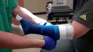 Application of a Thumb Spica Cast [upl. by Aletha]