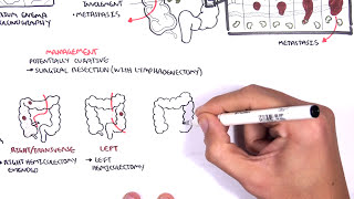 Colorectal Cancer  Overview [upl. by Falda]