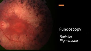 Retinitis Pigmentosa Fundoscopy [upl. by Nyrrek343]