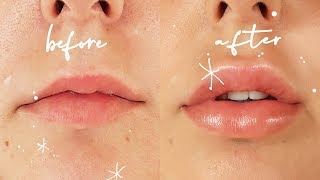 Getting Lip Injections  Before amp After VLOG [upl. by Atsirhcal]