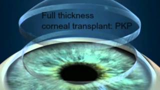 DMEK surgery sutureless corneal transplant [upl. by Hauge]