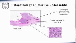 Endocarditis Pathophysiology [upl. by Evod]