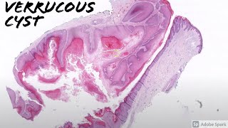 Verrucous Cyst 5Minute Pathology Pearls [upl. by Mendive116]