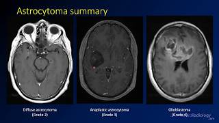 Animation  Spinal Cord Intramedullary Tumormov [upl. by Ettelohcin]