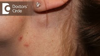 Causes of painful lymph nodes in neck  Dr Satish Babu K [upl. by Allicerp774]