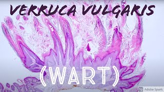 Wart Under the Microscope Verruca Vulgaris vs Seborrheic Keratosis Pathology [upl. by Oiramaj]