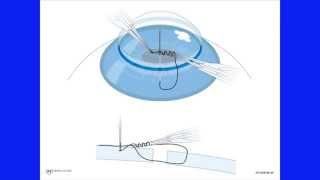 Corneal Crosslinking Procedure for Keratoconus [upl. by Dalli205]