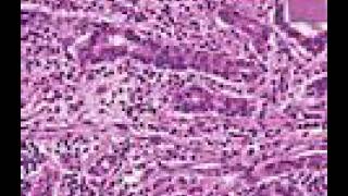 Cholecystitis vs Cholelithiasis vs Cholangitis vs Choledocolithiasis [upl. by Sosthina]