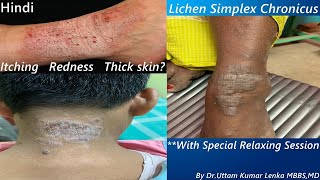 Lichen Simplex Chronicus  Treatment of thickened itchy skindry eczema treatment Dr Uttam Lenka [upl. by Nedle]