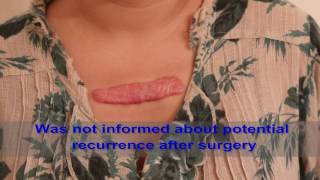 Chest Keloids  Mistakes to Avoid [upl. by Lothar]