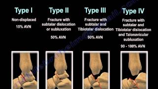 Talus Fracture Types  Everything You Need To Know  Dr Nabil Ebraheim [upl. by Selokcin]