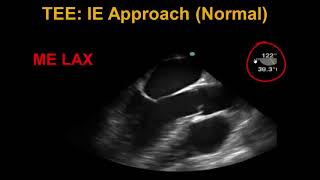 Transesophageal Echocardiography Infective Endocarditis [upl. by Enninaej]