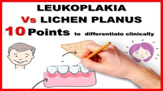 leukoplakia vs lichen planus  10 points to differentiate clinically [upl. by Dew67]