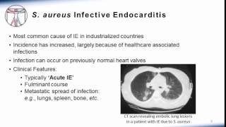 Endocarditis Microbiology and Treatment [upl. by Trici992]