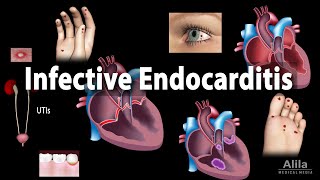 Infective Endocarditis Animation [upl. by Noet]