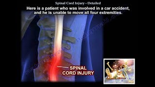 Spinal Cord Injury Detailed  Everything You Need To Know  Dr Nabil Ebraheim [upl. by Barker]