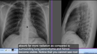 Differentiate Left and Right hemidiaphragms on chest xray lateral view [upl. by Fisa]