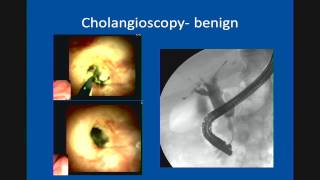 Primary Sclerosing Cholangitis Update in Management [upl. by Arley]