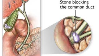 Choledocholithiasis amp Cholangitis [upl. by Ashlen]