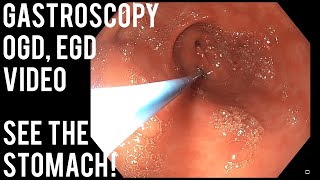 Gastroscopy  OGD  See inside the stomach [upl. by Ehcadroj796]