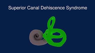 Superior Canal Dehiscence Syndrome SCDS [upl. by Ajit]