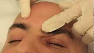 Sebaceous Hyperplasia removal [upl. by Rodrigo809]