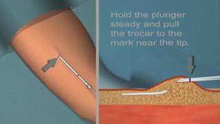 Jadelle insertion and removal Tutorial [upl. by Mercado]