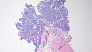 Bladder Cancer  Pathology mini tutorial [upl. by Tyre]