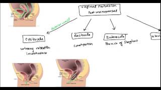 What is uterine prolapse  Dr Rubina Shanawaz [upl. by Medor546]