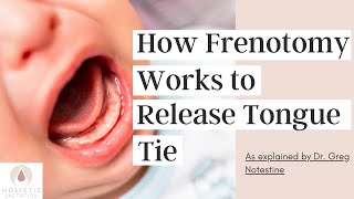 How Frenotomy Works to Release Tongue Tie [upl. by Nnaeus]