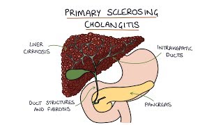 Scleroderma Pathogenesis and Clinical Manifestations Detailed Explanation [upl. by Queena686]