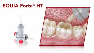 EQUIA Forte® HT  Restoration Guide [upl. by Xavier]