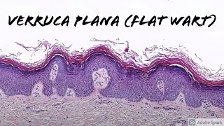 Verruca Plana Flat Wart under the microscope 5Minute Pathology Pearls [upl. by Emlynn]