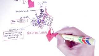 Emphysema  Introduction Types Symptoms Diagnosis [upl. by Ahsaet613]