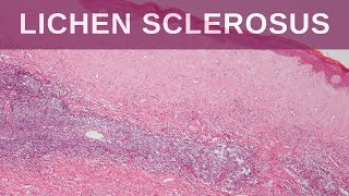 Lichen Sclerosus  Pathology mini tutorial [upl. by Jegger403]