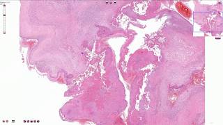 Infective Endocarditis  Histopathology [upl. by Rowell]