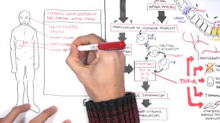 Idiopathic Inflammatory Myopathies  Polymyositis vs Dermatomyositis [upl. by Primalia]