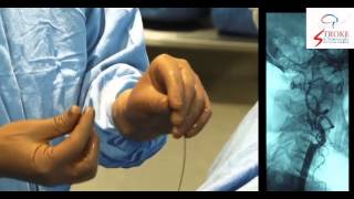 Live Carotid Artery Stenting [upl. by Ahseet]