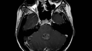 Ependymoma [upl. by Aynos]