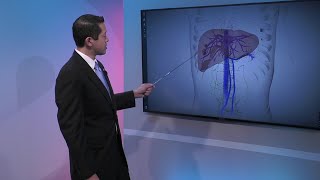 Liver Cancer Staging [upl. by Molli]