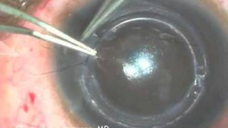 Intacs Insertion for Keratoconus [upl. by Hampton]