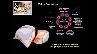 Talus Fractures  Everything You Need To Know  Dr Nabil Ebraheim [upl. by Aber]