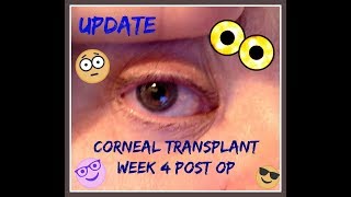 Full Thickness Corneal Transplantation Penetrating Keratoplasty PKP [upl. by Apilef951]