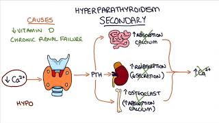 Understanding Hyperparathyroidism [upl. by Harvie743]